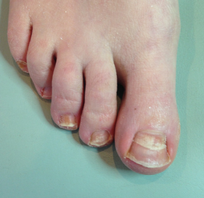 foot before Nail Reconstruction