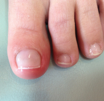 After Nail reconstruction 2